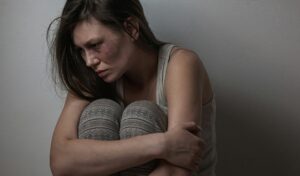 Domestic violence, abuse woman with bruise on face